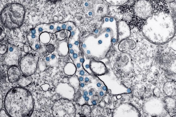 Transmission electron microscopic image of first U.S. coronavirus case